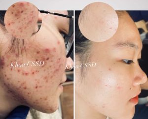 Cùng Sinh viên Khoa Chăm Sóc sắc đẹp học điều trị mụn